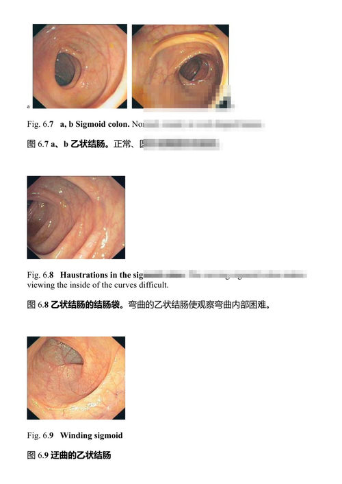 结肠镜检查图谱 赫尔穆特·梅斯曼 (中英对照电子书)