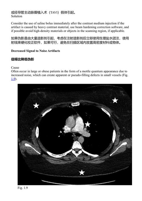 胸部CT检查中的偶发性心血管发现 勒内·E·坎扎 (中英对照电子书)
